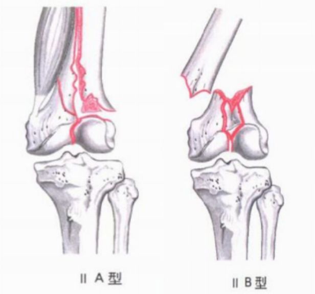 内收型:pauwels角>50度,为极不稳定型 Ⅲ型:并发髁上或干骨折六,髌骨