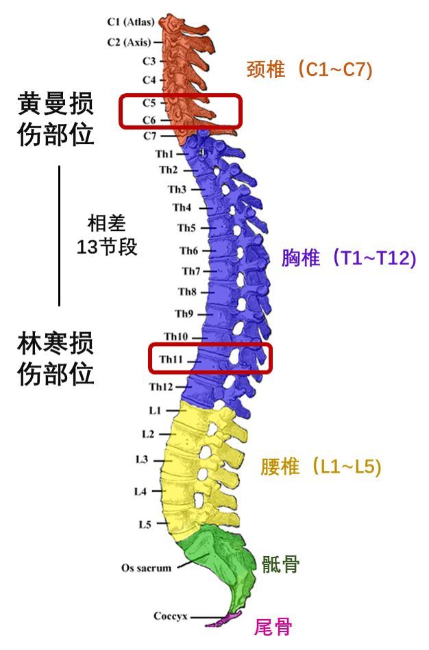 林寒,是胸椎的t11区受损,肚脐以下的疼痛感完全消失.