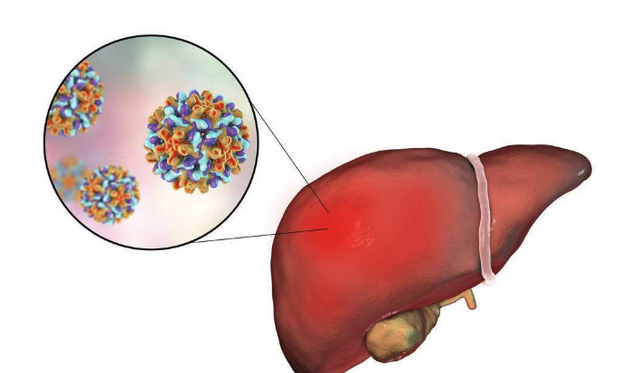乙肝最终都会发展成为肝癌!做好这5点试试