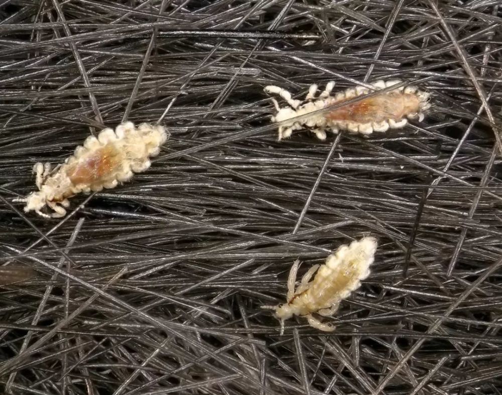 去医院要看皮肤科 当怀疑孩子的头发上有虱子,应及时到医院就诊,看