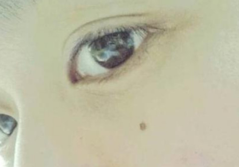 如何辨别癌症痣?若出现有这5个特征,就要警惕