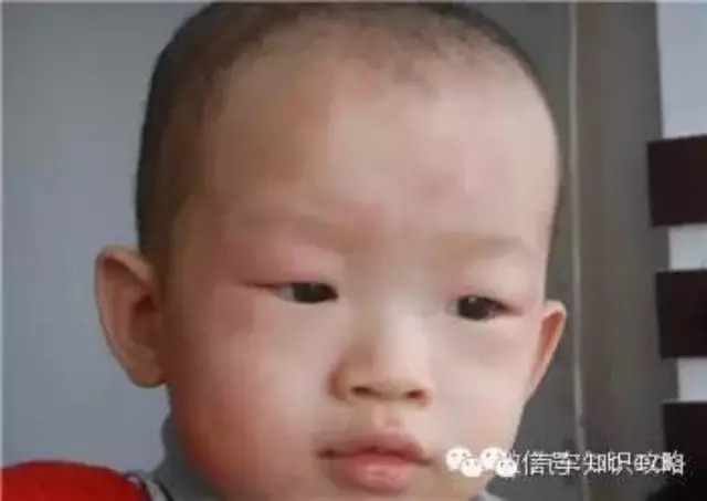 <em>孩子</em>长红疙瘩,被医生建议回家翻看枕头,真相毛