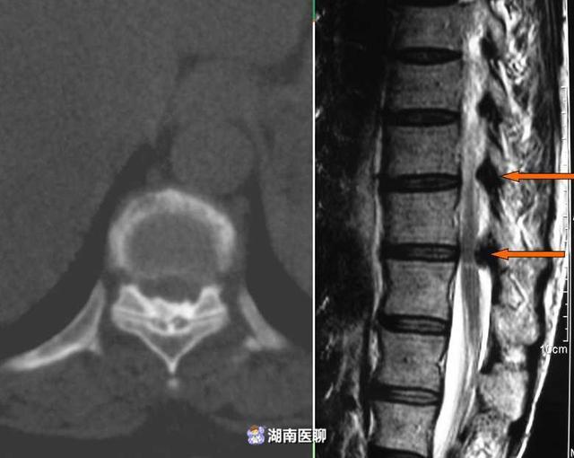 黄韧带骨化(t9～l1) 并脊髓损伤(不全瘫痪 ),还有 颈椎病颈椎间盘突出