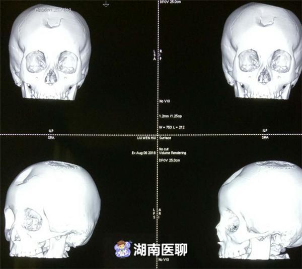 衡阳女子严重摔伤,颅骨凹陷下肢畸形,医生这样手术避开并发症