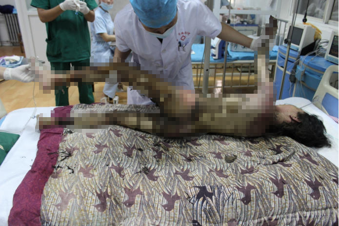 16岁女孩全身烧伤 母亲因无钱救女陷入绝望