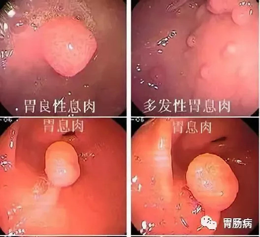 仅供医学专业人士阅读参考 为什么会长息肉? 一 什么是胃息肉?