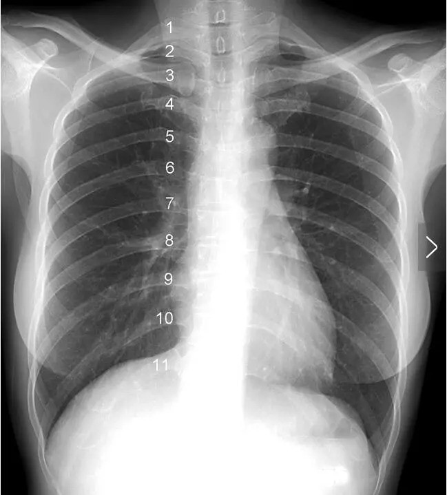 影像解剖入门|正常胸片怎么看?