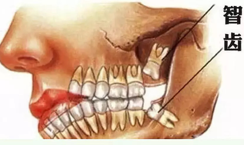 【健康知识】智齿到底要不要拔?你想知道的都在这!