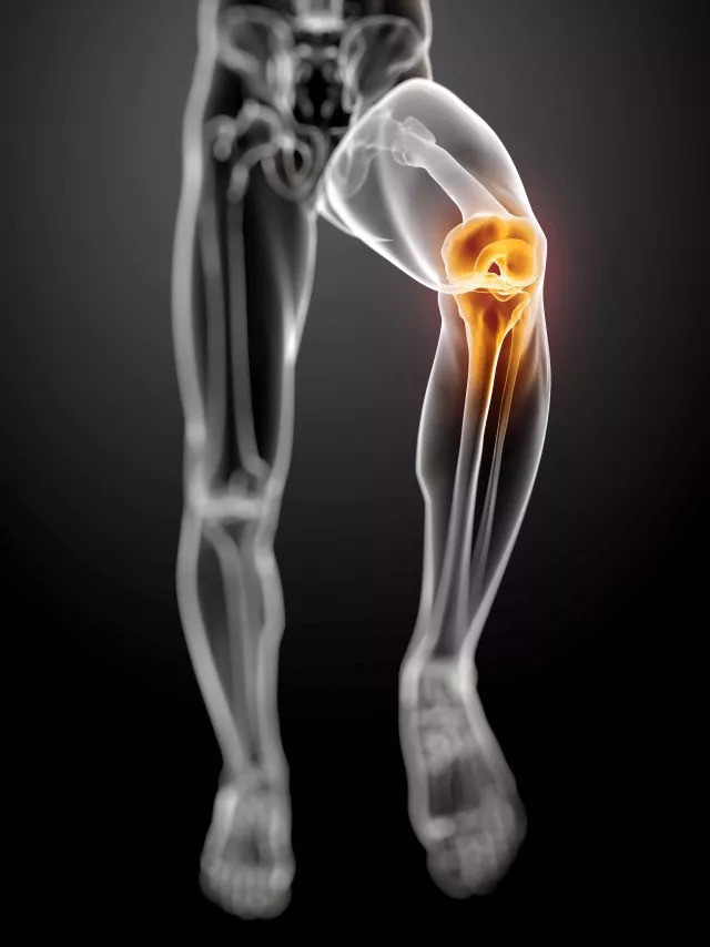 骨癌多发生在膝关节 ct可检出