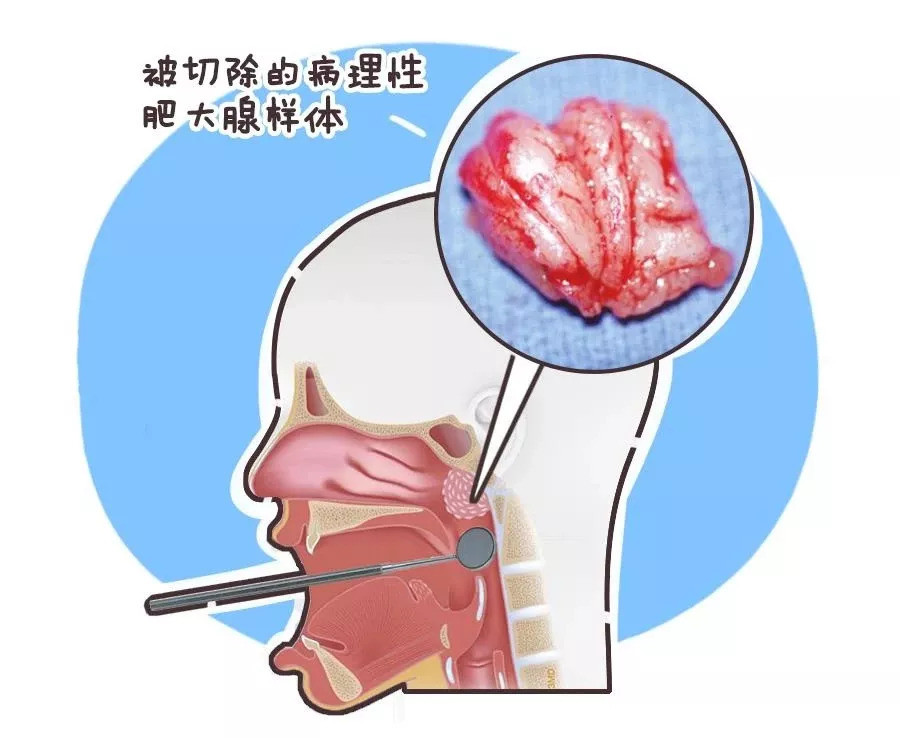 孩子睡觉打鼾,张嘴呼吸这个习惯,可能是"腺样体肥大"