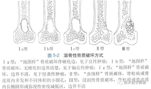 一文掌握|骨肿瘤分析因素与诊断思路