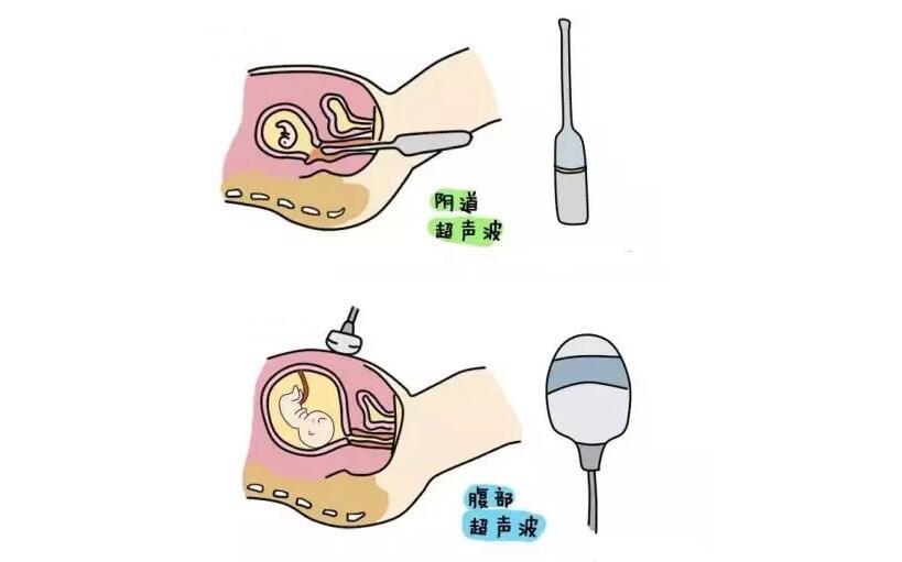 怀孕能不能做阴式彩超,会不会伤害宝宝?