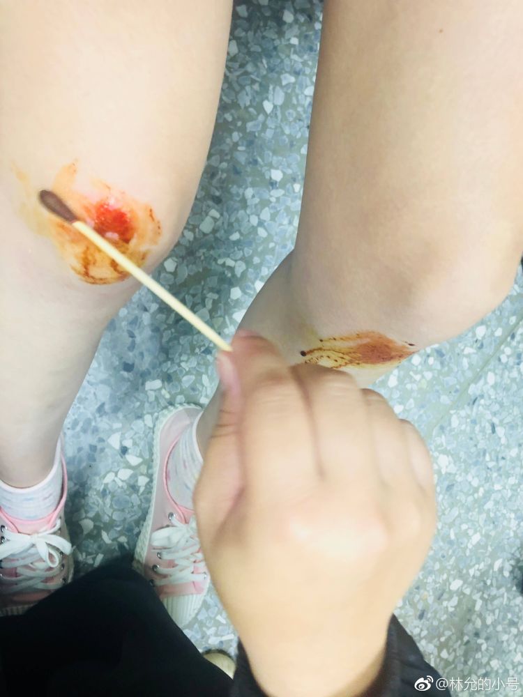 林允自曝拍戏受伤,膝盖红肿流血,受伤原因竟因