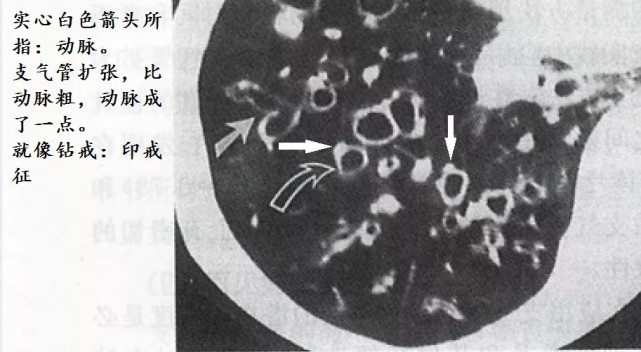 经典图谱,详细解说支气管扩张ct小诀窍!学不会我拜你