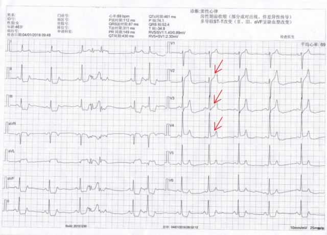 【病例帮】如何正确识别心电图wellens综合征样t波