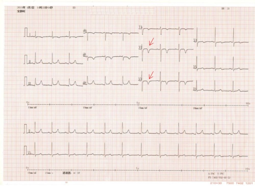 【病例帮】如何正确识别心电图wellens综合征样t波改变?