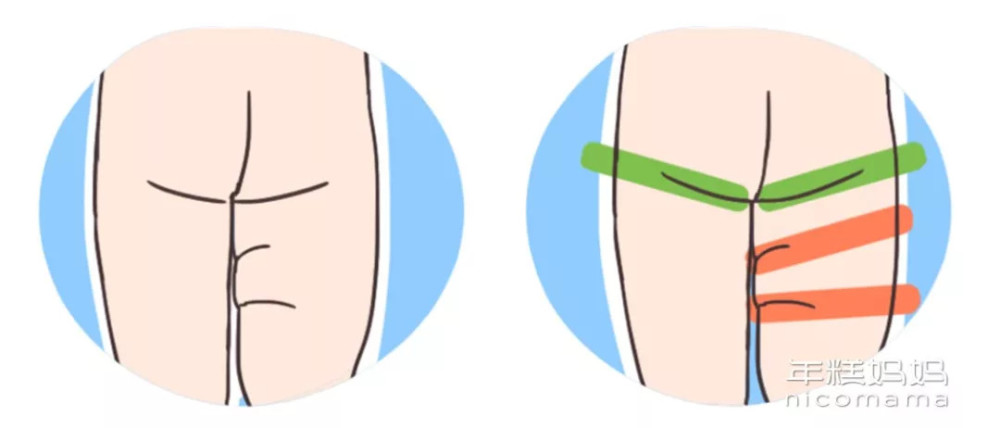 带娃做过体检的爸妈都知道,医生会观察婴儿双腿是否一样长,大腿能不