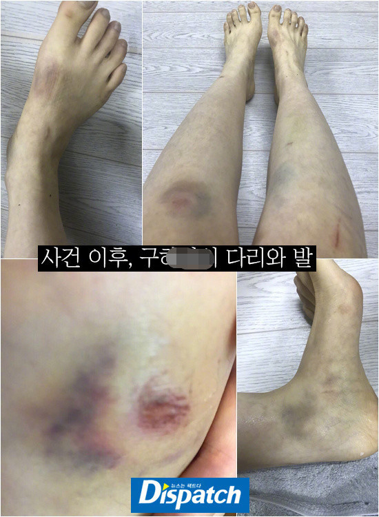 韩女星具荷拉竟与男友相互殴打,家暴受伤照曝光惨不忍