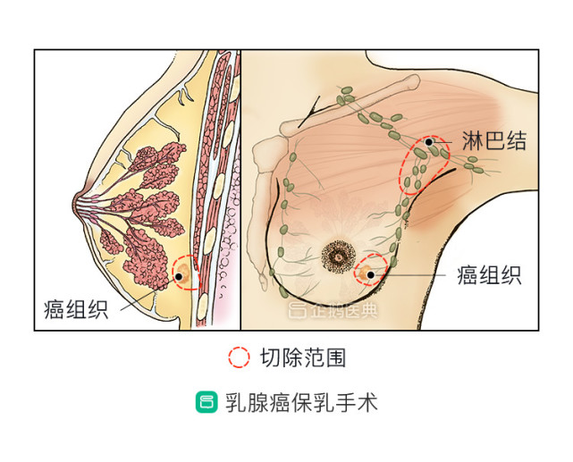 患了乳腺癌,担心乳房被切?保乳手术来帮你