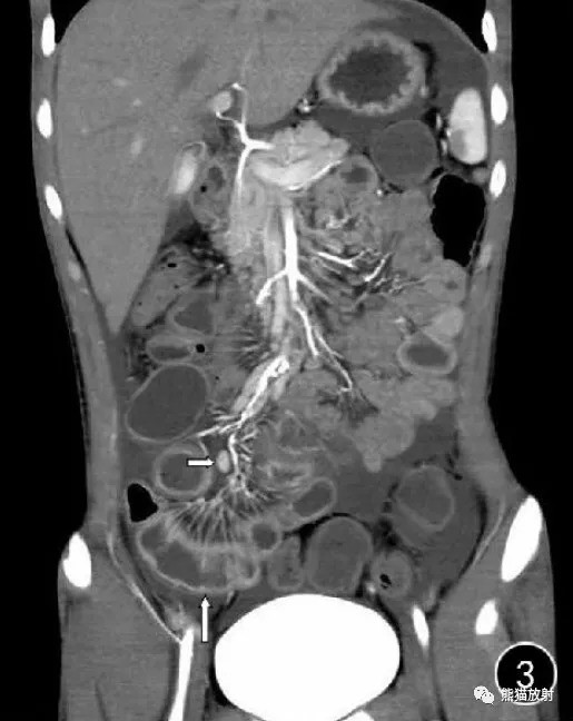 小肠肠壁增厚,CT小肠造影征象和诊断
