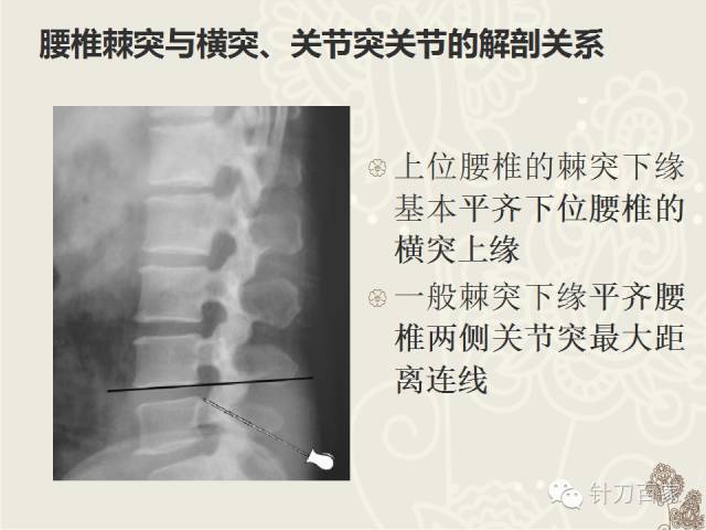 腰椎棘突在针刀定位治疗中的应用