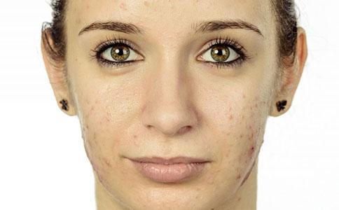 痤疮会传染吗?真相到底是什么?预防唑疮正确