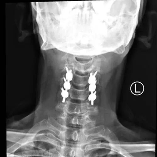 常德一男子工地干活被砸致瘫痪 一月后竟能下