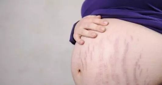 谢依霖的妊娠纹，才是女人真正怀孕的样子啊!