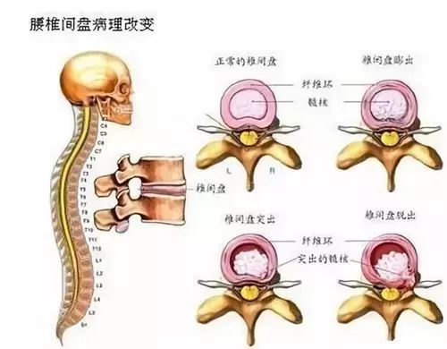 腰椎间盘突出≠腰椎间盘突出症?一字之差,你可能没病