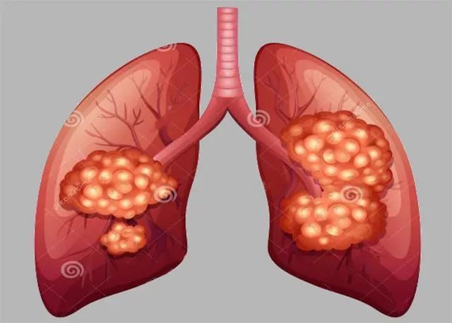 如果肺功能和身体状况都不错的肺癌患者,即使切除一边肺还是有可能
