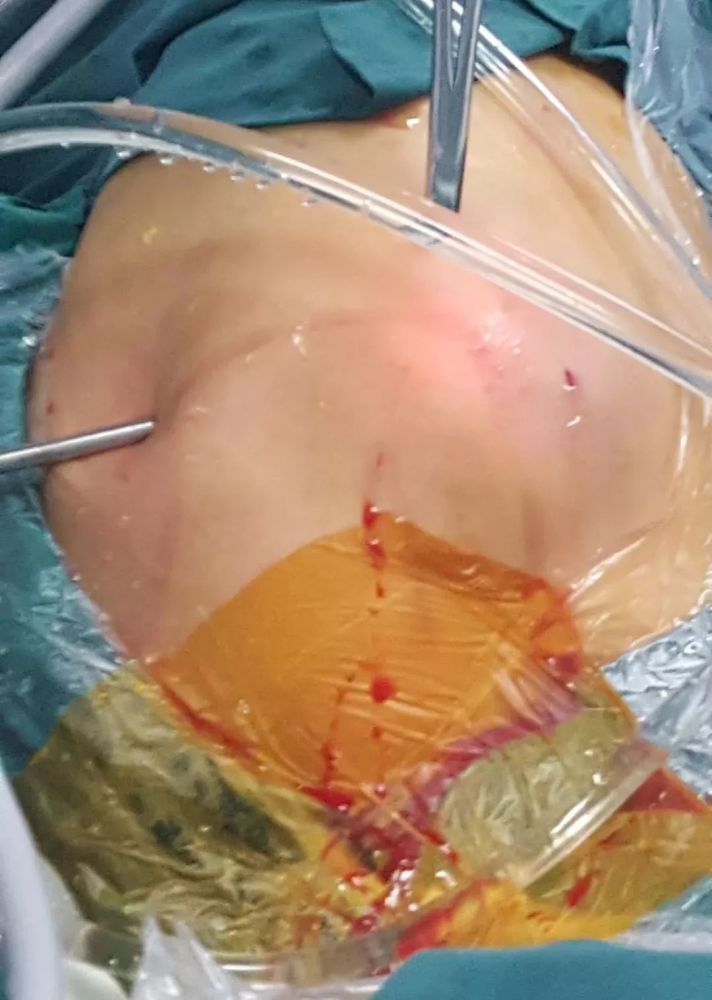 肩关节脱位时x线 手术情况: ( 来源:张银龙医生微信公众号;部分图片