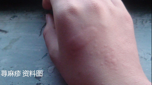 【震惊】女子住完酒店浑身瘙痒,患上了这个病