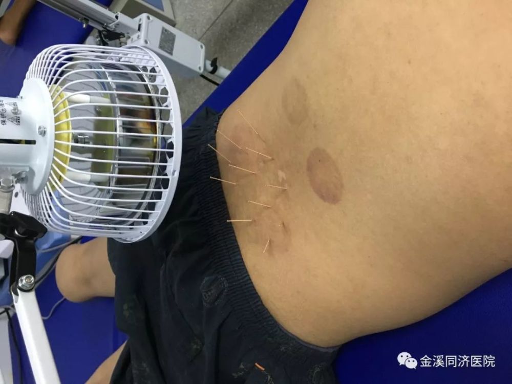 小针刀,似针又似刀,颈肩腰腿痛,几分钟见效