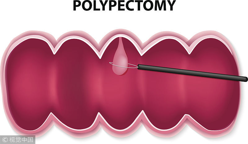 身体出现三个信号，提醒你该检查一下肠镜，大肠息肉可能已经找上