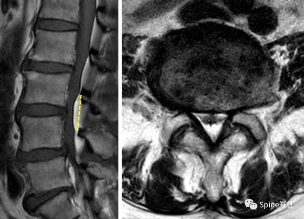 骨科精读|mri提示腰椎管狭窄症的几个特殊征象,看这篇