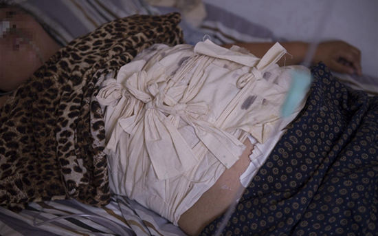 女子患怪癖吃钉子玻璃上瘾 不停做开腹手术