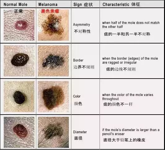 你身上的黑痣会不会"要命"?首先要区分这六点!