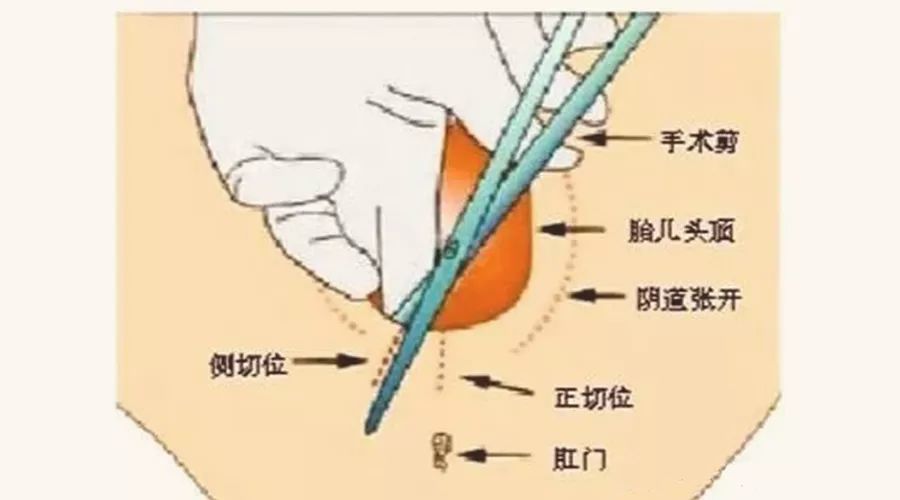 顺产真的要剪下面?听听妇产科医生怎么说