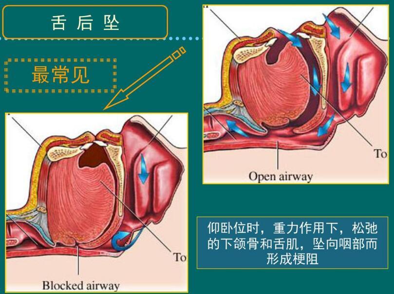 舌后坠后果严重