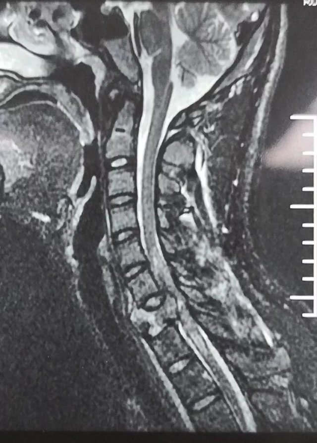 长沙17岁男孩边玩手机边骑车 结果出车祸致高