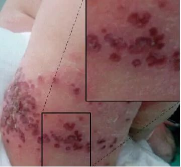 1岁半女娃手臂疹子连成片,竟是被妈妈传染的