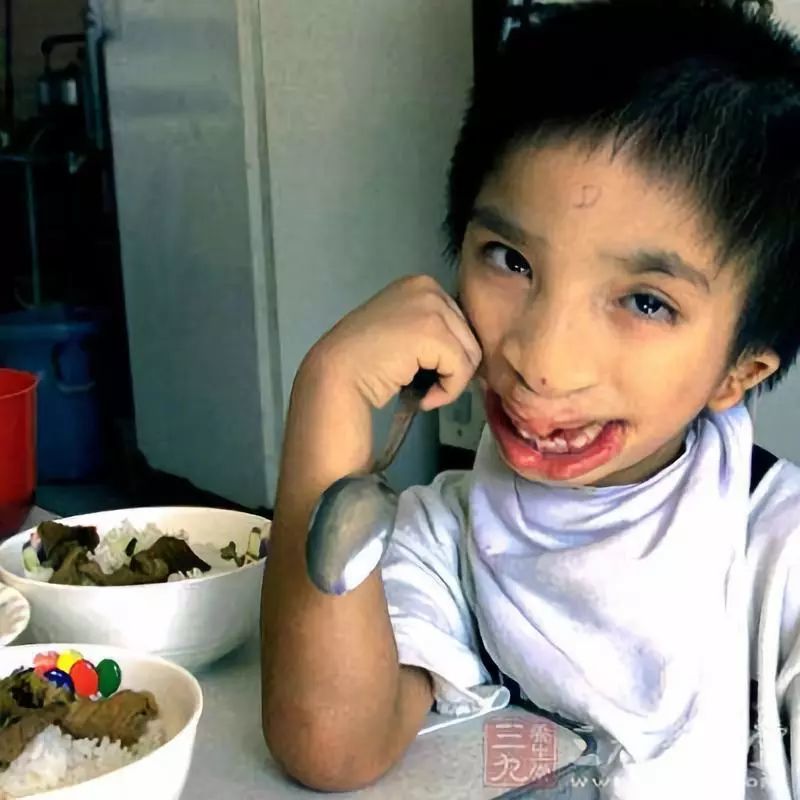 先天性愚型 腾讯网