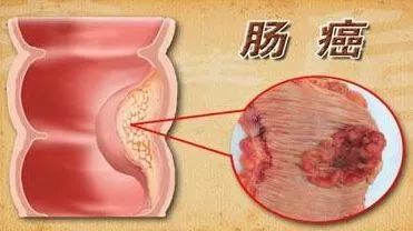 女性肠癌六种信号是什么（女性肠癌六种信号）