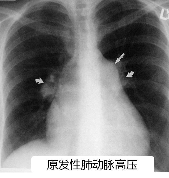 x线的其他应用 心脏手术后复查 起搏器植入术后复查 中心静脉置管后