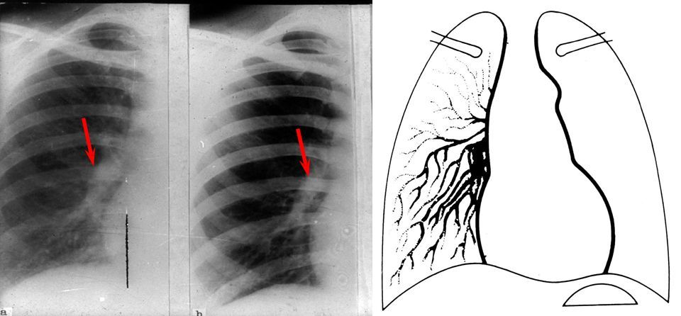 心脏增大,右室增大 fallot四联症(tetralogy of fallot) 肺动脉漏斗部