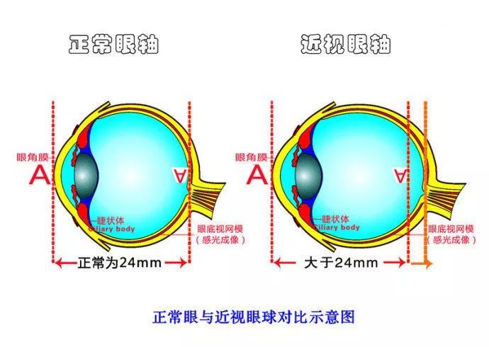 800度近视还有救吗?有,方法还不止一种