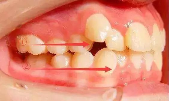 导致牙齿不齐的坑有很多,你入的是哪个坑?