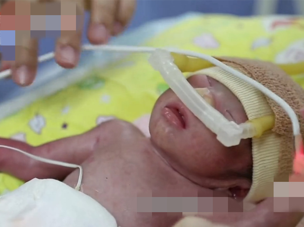 二胎孕妇患有8项孕期合并症,早产生下的宝宝只