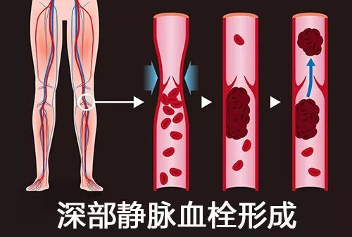 腿血栓 腾讯网