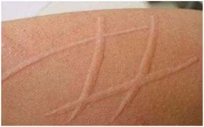 宝宝出疹误当普通过敏险致命?荨麻疹不寻常,熟